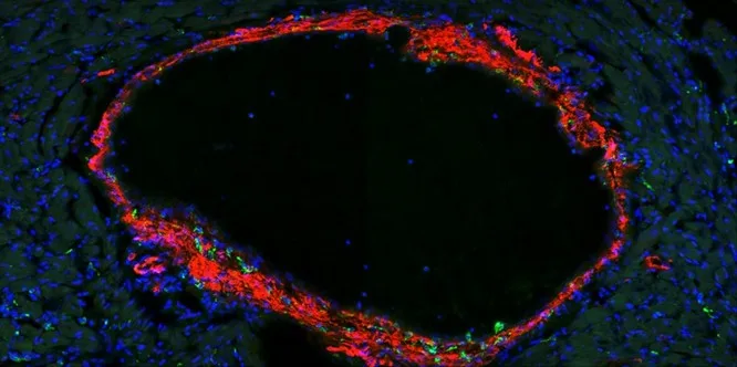 Identifican mecanismo clave en daño de arterias coronarias ligado a enfermedad de Kawasaki